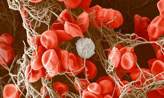 ارتباط کرونا و تشکیل لخته خون!