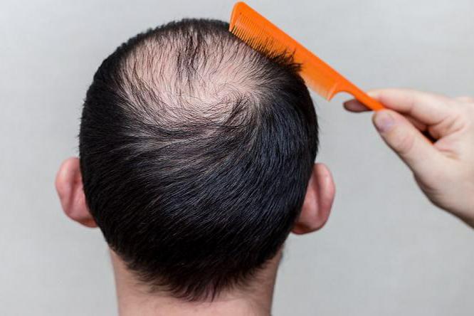 عوامل کم پشتی و چند روش خانگی برای افزایش تراکم موها