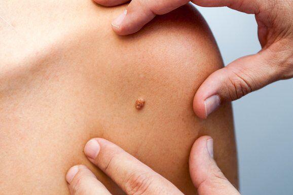 پیشگیری از عود وخیم ترین نوع سرطان پوست 