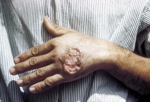 شناسایی مبتلایان به بیماری انگلی و پوستی سالَک در ۱۸ استان ایران/علائم پوستی چند ماه بعد از نیش پشه خاکی آلوده بروز می کند