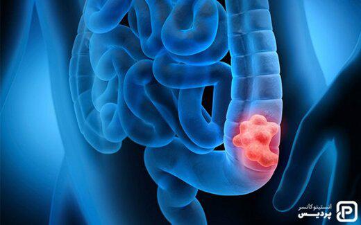 استان های رکورددار سرطان روده در کشور