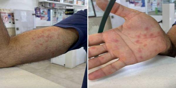 هشدار؛ اگر این علائم را دارید آبله میمونی گرفته‌اید