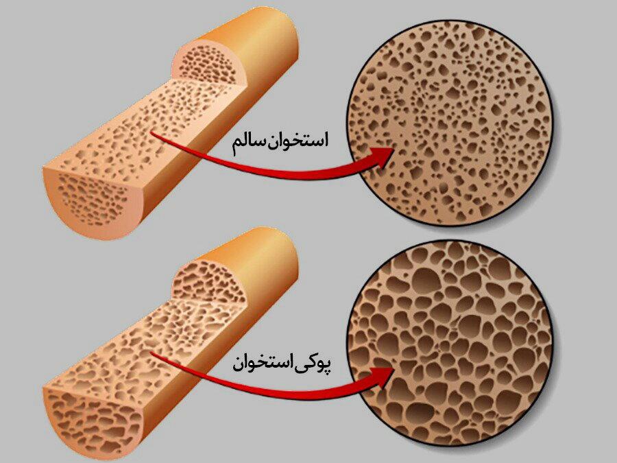 ویتامینی که بیماری خاموش را ضربه فنی می کند