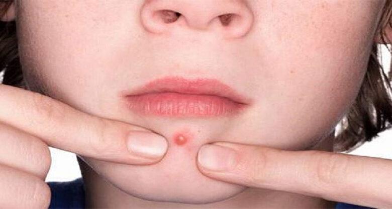جوش های صورت خود را فشار ندهید 