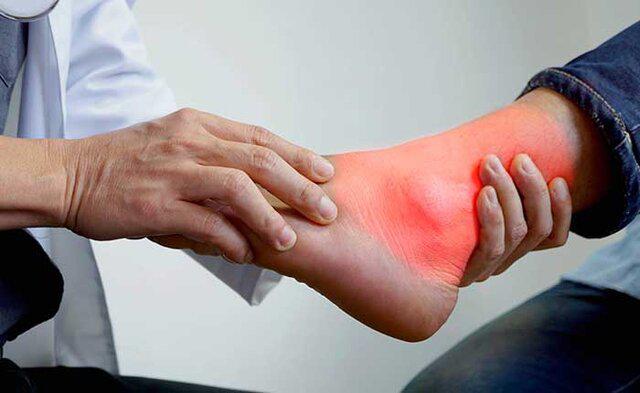  نقرس چه زمانی رخ می دهد؟