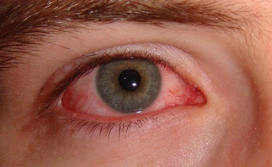 با التهاب چشم، ناشی از حساسیت چه کنیم‌؟