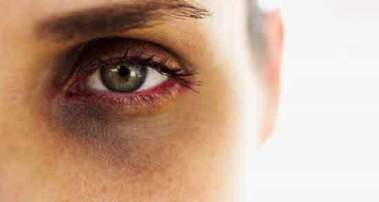 چه عواملی باعث تیرگی دور چشم می‌شوند؟