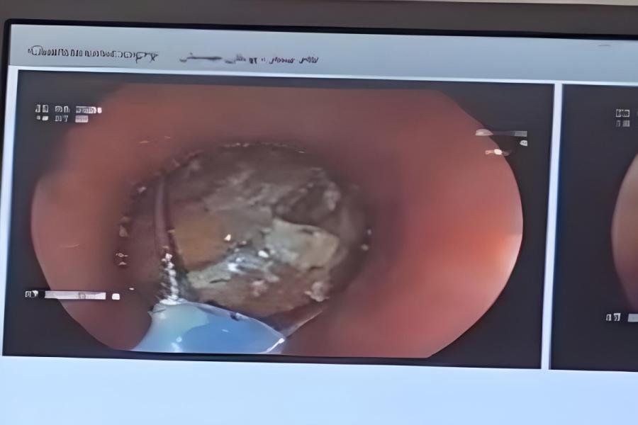 خارج کردن فندق از مری کودک ۱۰ ساله در بیمارستان ۱۷ شهریور رشت