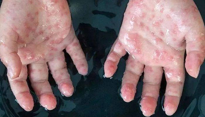 علائم بیماری آبله میمونی چیست؟