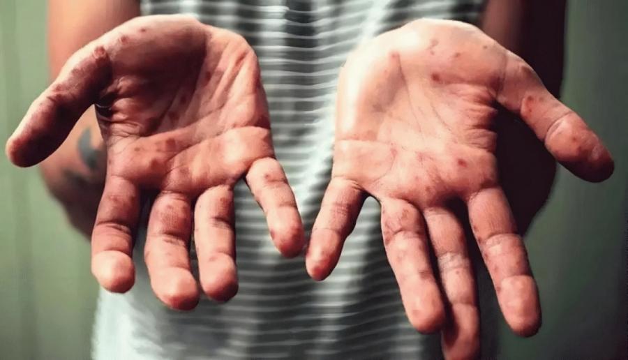 هرآنچه باید درباره آبله میمونی بدانیم