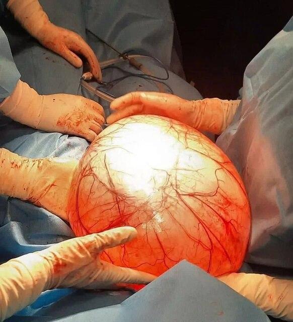 خارج کردن توده ۱۰ کیلویی از شکم زن ۲۶ ساله‌ای که تصور می‌کرد چاق شده