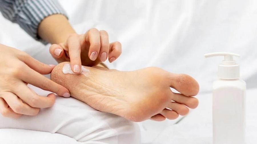 کمبود کدام ویتامین‌ها سبب ترک پاشنه پا می‌شود؟