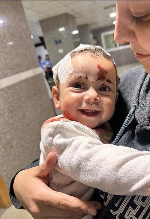 عکس پربازدید از لبخند شیرین کودک لبنانی که در حمله اسرائیل مجروح شد
