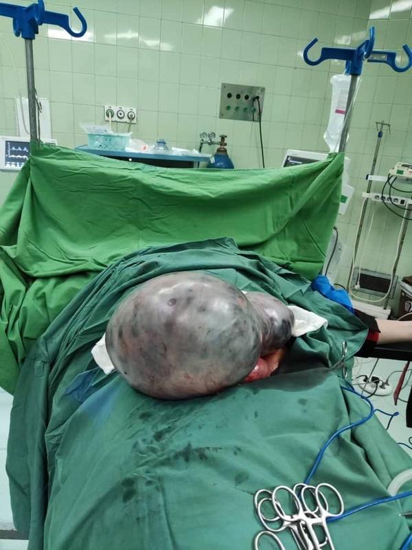 عمل جراحی نادر خروج توده شکمی ۲۰ کیلویی در سوادکوه