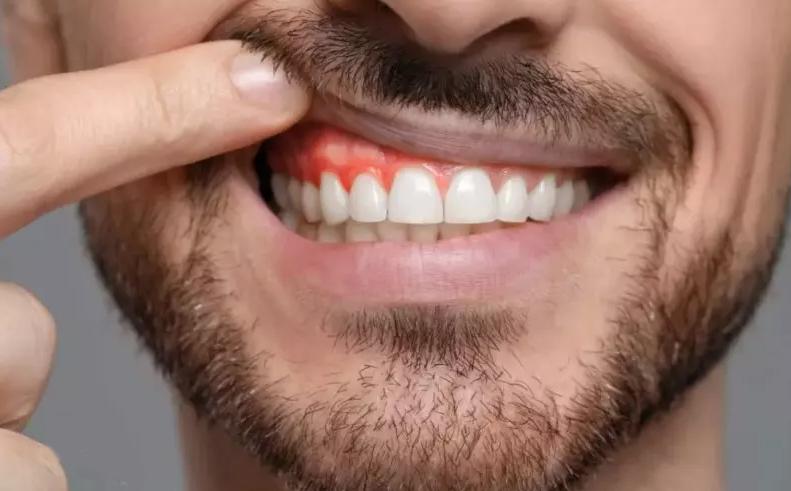 ارتباط بین بیماری لثه و عملکرد مغز