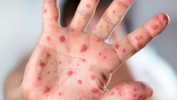 بیماری سرخک از کدام کشور وارد ایران شد؟ / سرخک به‌شدت واگیردار است