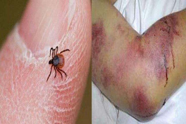 اوج فعالیت کنه‌ها در فصل گرما