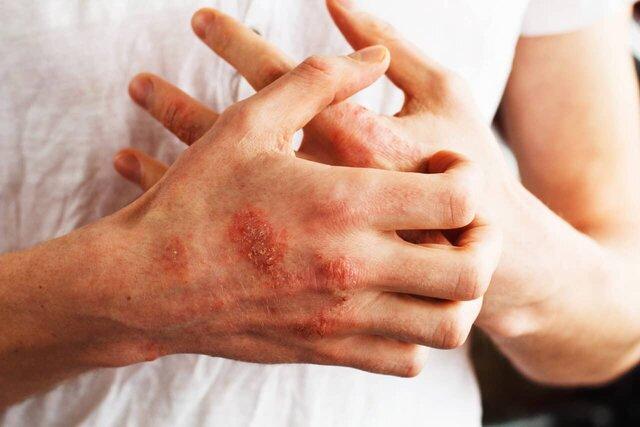 چرا تشخیص بیماری‌های خودایمنی دشوار است؟