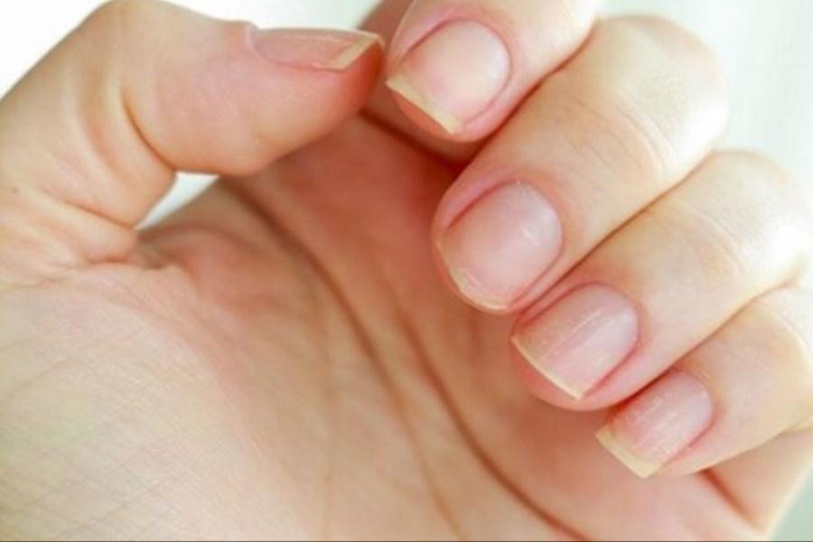۷ علامت هشداردهنده کلسترول بالا در ناخن کدامند؟