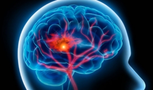 پایین بودن سطح کلسترول و خطر سکته مغزی