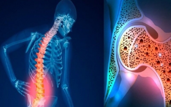 راه های جلوگیری از پیشرفت پوکی استخوان را بشناسید