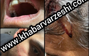 داداش زاده:بعد از سلب آرامش،سر و دندانم را هم شکستند 