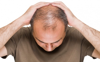 افراد طاس به نوع شدید کرونا مبتلا می شوند؟