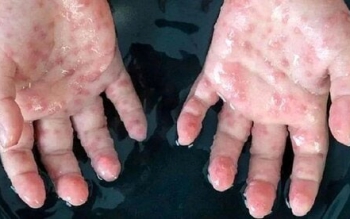 وزارت بهداشت:۶ بیمار مشکوک به آبله میمون را شناسایی کرده‌ایم