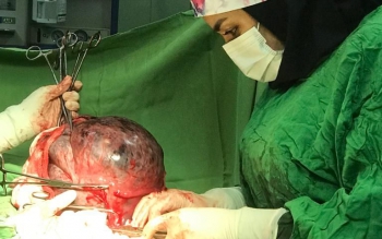 خارج کردن توده ۵ کیلویی از شکم مادر باردار در رشت؛ جنین سالم است 
