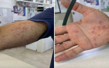 هشدار؛ اگر این علائم را دارید آبله میمونی گرفته‌اید