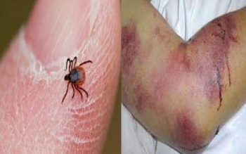 راه‌اندازی شبکه تشخیصی تب کریمه کنگو در کشور/ مشاوره ایران به کشورهای همسایه