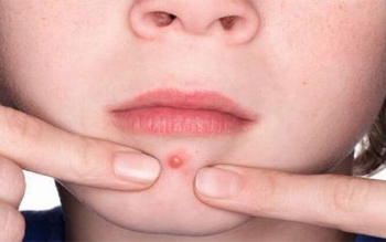 جوش های صورت خود را فشار ندهید 