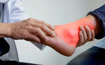  نقرس چه زمانی رخ می دهد؟
