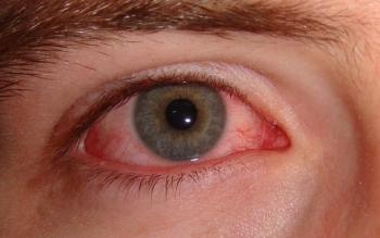 با التهاب چشم، ناشی از حساسیت چه کنیم‌؟