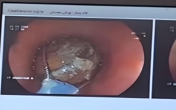 خارج کردن فندق از مری کودک ۱۰ ساله در بیمارستان ۱۷ شهریور رشت