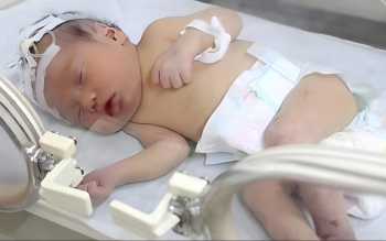 قطع نخاع نوزاد ۵ ماهه بر اثر شکستن قلنج توسط عمه