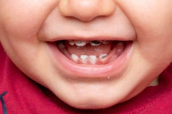 مدیر دفتر بهبود تغذیه جامعه وزارت بهداشت:  قطره آهن در نوزادان باعث پوسیدگی دندان‌ها نمی‌شود