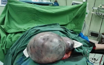 عمل جراحی نادر خروج توده شکمی ۲۰ کیلویی در سوادکوه