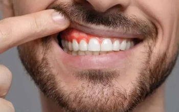 ارتباط بین بیماری لثه و عملکرد مغز