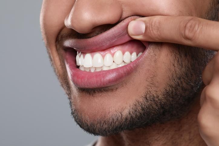 علت تیره شدن لثه و راه درمان آن چیست؟