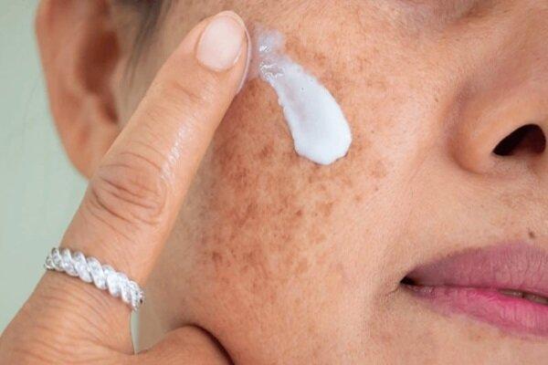 آشنایی با انواع لک‌های پوستی و روش درست مقابله با آنها