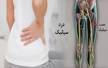 سیاتیک را با گرفتگی عضلات اشتباه نگیرید