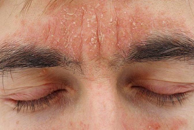 روش‌هایی ساده برای کاهش خشکی پوست