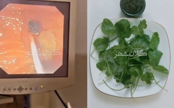 فیلم/خارج کردن انگل زنده «فاسیولا» از مجرای صفراوی زن ۳۸ ساله در رشت