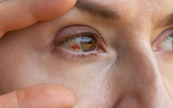 دلایل پارگی رگ خونی در چشم؛ چه موقع باید به پزشک مراجعه کنیم؟